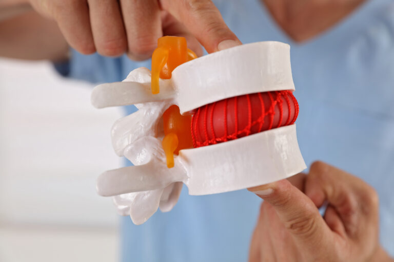 model of spinal disc for spinal decompression mckinney TX