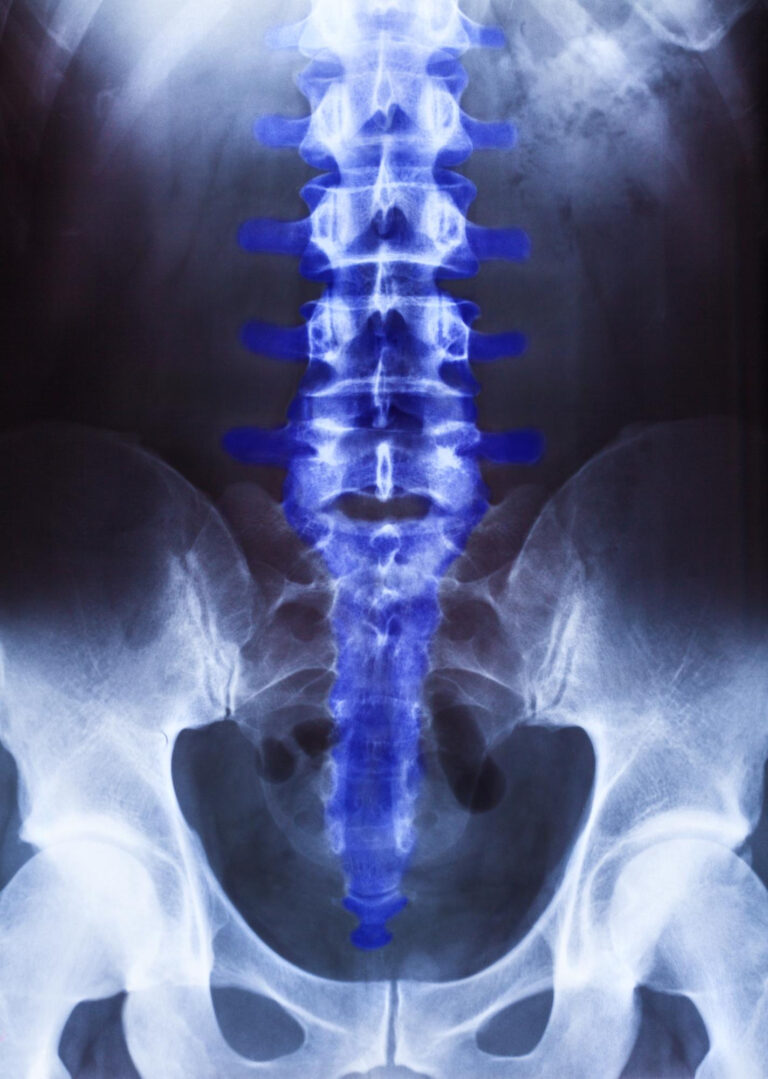 x-ray of lower spine as part of our Chiropractic Care McKinney TX