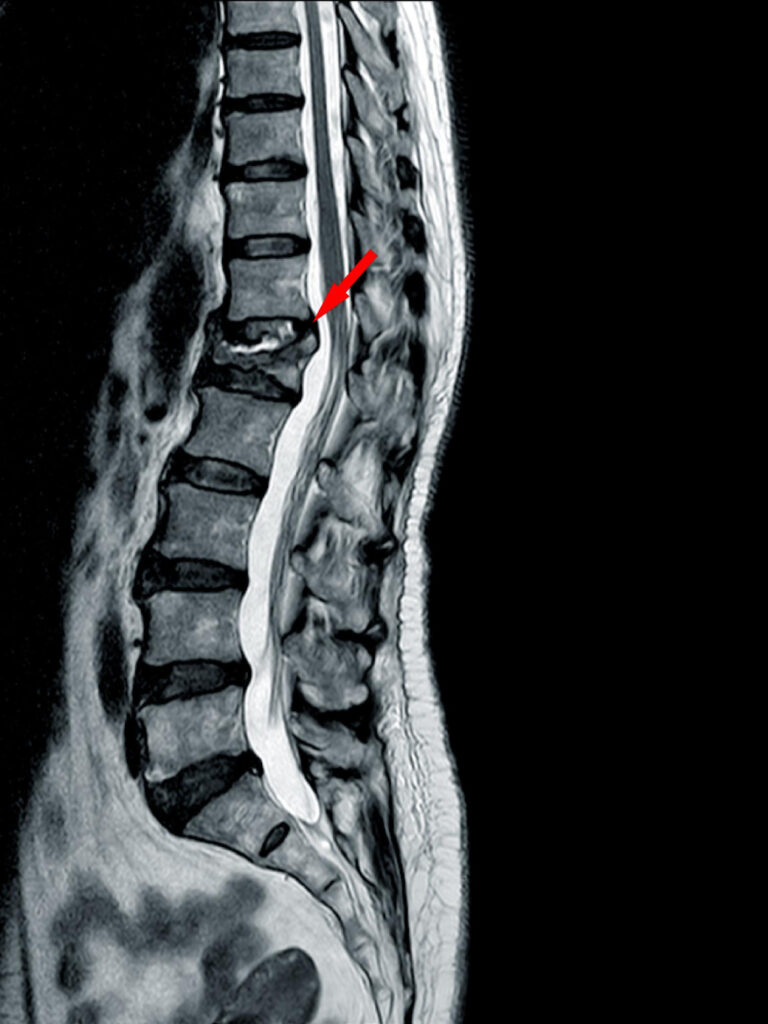 x-ray of spinal disc injury spinal decompression therapy in McKinney TX